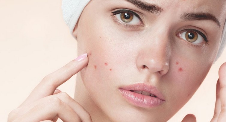 Acne - What Foods Cause Acne