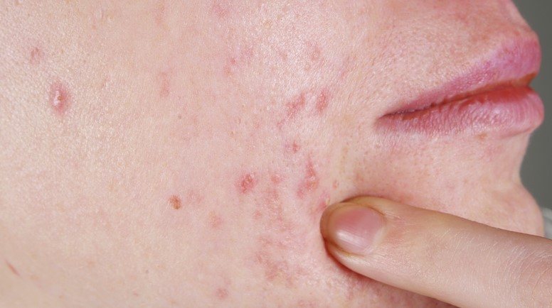 What foods help cause acne?