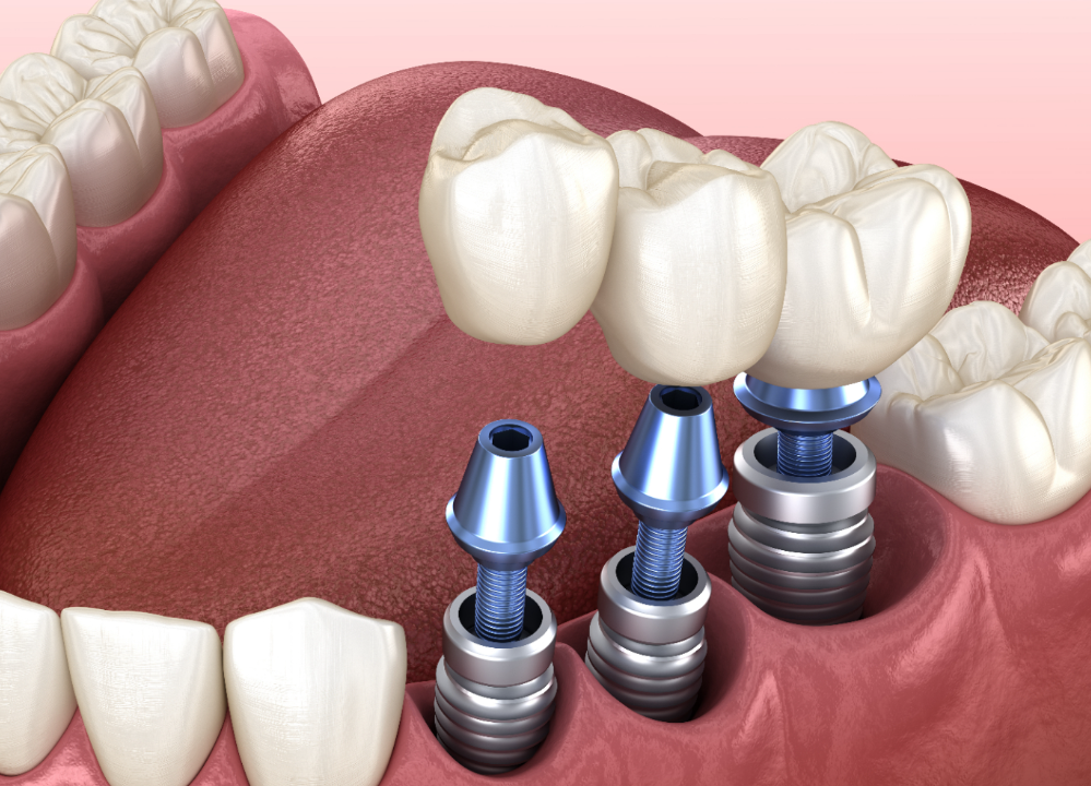 Key Aspects to Know About Dental Implants