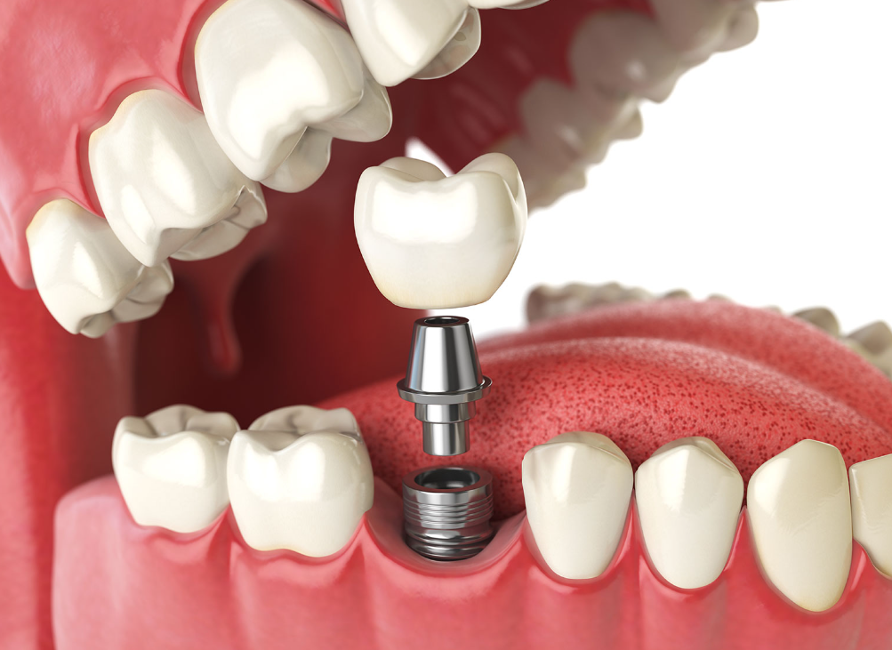 Key Aspects to Know About Dental Implants