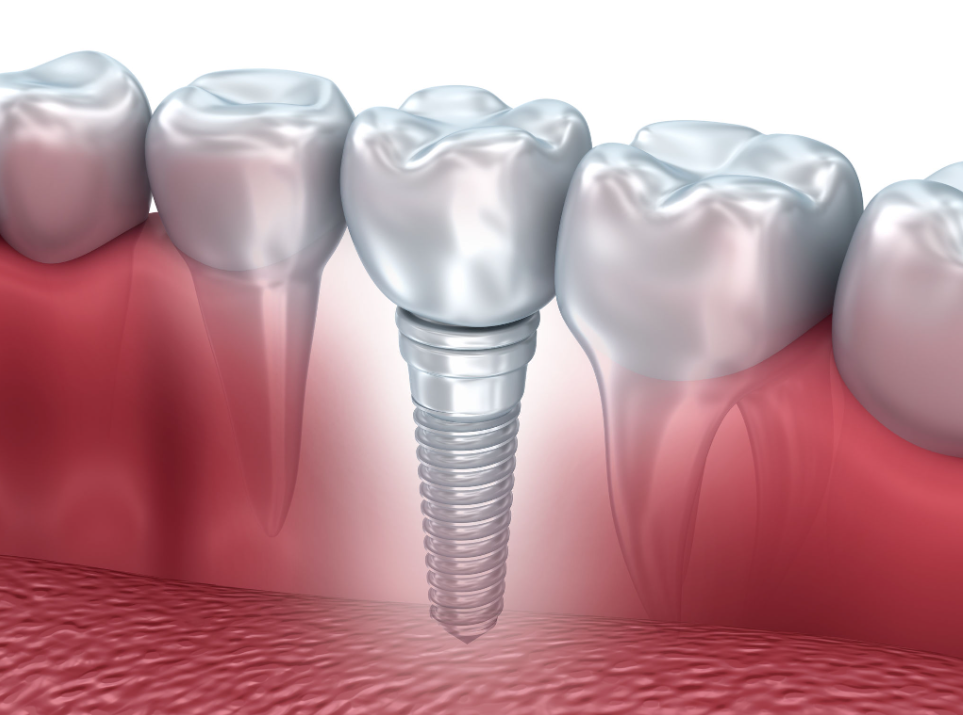 Key Aspects to Know About Dental Implants